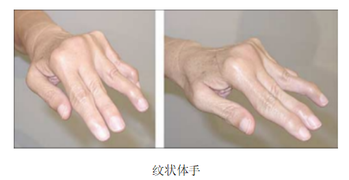 科普|手抖不害怕，康复有方法——帕金森病患者手功能居家康复护理指导