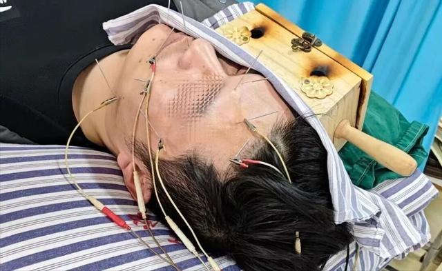 男子一觉醒来“面部失控”，茎乳孔注射治疗为其“拨正”容颜